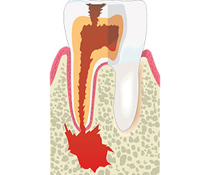 Why Are Root Canals Important? | Root Canal | Dr Sidelsky