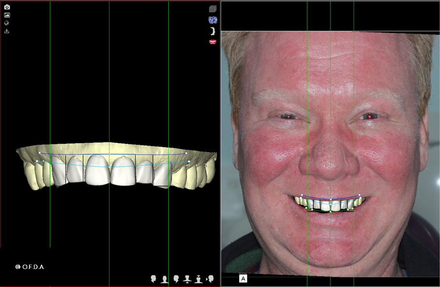 Digital Smile Design | Digital Photo Cosmetic Dentistry | Dr A. Sidelsky 